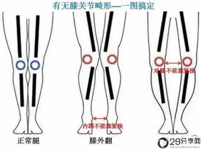 长短腿怎么矫正(长短腿相差2厘米严重吗) 7