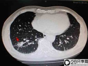 肺癌的症状和前兆是什么？(肺癌前期有什么症状)
